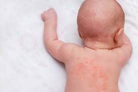 It typically looks dry, flaky, or ashy. How To Treat Baby Rashes At Home Tips And Remedies