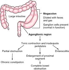 The opposite of diarrhea, cats can also experience hard, difficult to pass stools. Megacolon Definition Of Megacolon By Medical Dictionary
