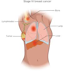 These include how sensitive it is to the hormones estrogen and when and how does my doctor determine the stage of my breast cancer? Stages Grades Of Breast Cancer My Breast Cancer Compass