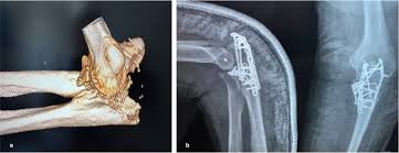 Image result for Coronoid Process Fracture