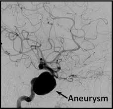 These checks are usually done with a magnetic resonance imaging (mri) scan. Brain Aneurysm Radiology