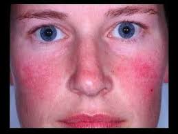 La peau s'épaissit et a une texture bosselée. Rosacee Medecine Integree