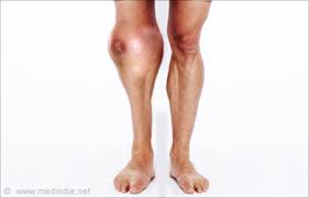 My knowledge is based on my personal. Osteosarcoma Predisposing Factors Symptoms Signs Diagnosis Treatment