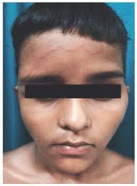 Parasite Infestations in Cutaneous Infections