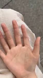 Image result for Supernumerary Digit