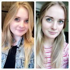 Thickened skin of lower legs with a pale or yellowish appearance. Face De Puffed 2 Months Post Diagnosis And Levothyroxine Hypothyroidism