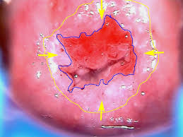 Implementation of pap screening markedly reduces rate of cervical cancer. Colposcopy Digital Atlas