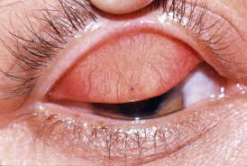 Image result for Conjunctival Foreign Body