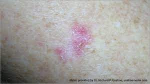 Navigating the choices for skin cancer treatment starts with understanding your options. Skin Cancer Pictures Photos Pictures Of Skin Cancer