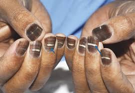 This fingernail condition includes black lines on the nails, nail discoloration, and/or excessive pigmentation. What Caused This Man S Nail To Turn Brown And Striped Live Science