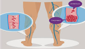 Hay dos sistemas venosos, profundo y superficial. Atencion Estos Son Los Sintomas De Trombosis Venosa En Las Piernas Delicias Blog