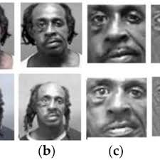 A subject with markedly different left and right ears.