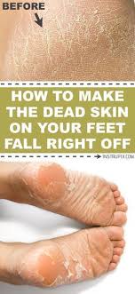 Foot Soak For Dead Skin That Actually Works Soft Feet Remedy Dry Skin On Feet Dead Skin On Feet