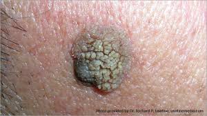 Skin cancer is the most common type of cancer in the united states by a pretty large margin, and it does not discriminate. Melanoma Brisbane