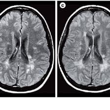 Mri, which can reveal areas of ms (lesions) on your brain and spinal cord. Serial Mri In A Patient With Relapsing Remitting Multiple Sclerosis Download Scientific Diagram