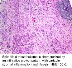 Luckily for epithelioid mesothelioma patients, their diagnosis is the most common for this disease. Pathology Outlines Peritoneal Malignant Mesothelioma