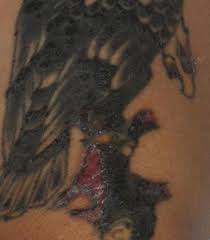 There is an increase in both the number of people getting tattoos and the number of skin cancers, so invariably there will be skin cancers that will develop in a tattoo. Inflammatory Tattoo Reaction Dermatology Advisor