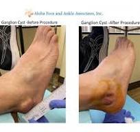 What is a ganglion cyst?: Aloha Foot and Ankle Associates ...