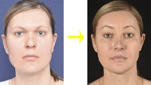 Facial Feminization Surgery Results Facial Feminization Surgery Facial Surgery Facial