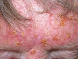 Conditions treated by fluorouracil (5fu) Fluorouracil Cream Dermnet Nz