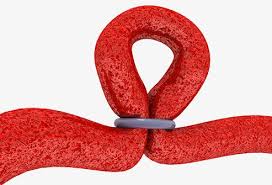 Tubal Ligation Side Effects Recovery Steps In The Procedure