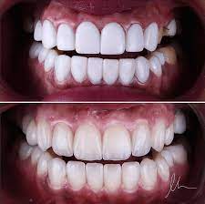 Dental veneers do not require any special care. Your Teeth Should Look Natural Not Fake Veneers Dental Teeth Veneers Teeth Aesthetic Dentistry Dental Aesthetics
