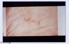Image result for Trombicula autumnalis bites