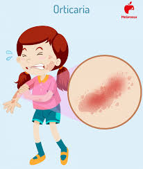 È possibile manifestare una reazione acuta in relazione ad un particolare evento stressante, oppure notare che una preesistente orticaria cronica peggiori a seguito di stress finanziario, personale o professionale. Orticaria Cos E Classificazione Cause Sintomi Trattamenti E Prevenzione