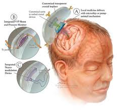 Implantable shunt devices are critical and life saving for hydrocephalus  patients. However, these devices are fraught with high complication rates  including scalp dehiscence, exposure, and extrusion. In fact, high shunt  valve profiles