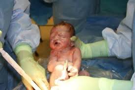 If your health care provider has put strips of tape on your incision, let them fall off on their own, or remove them after a week. Doctors Performing C Sections Shouldn T Make Unnecessary Cuts Huffpost Canada Life