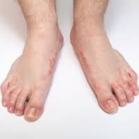 Understanding these helps a person determine why they have one and take the. Management And Treatment Options For Common Foot Conditions Learning Article Pharmaceutical Journal