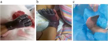 Hemostatic changes in patients with liver disease may result in bleeding or, rarely, thrombosis. Genotypic And Phenotypic Character Of Chinese Neonates With Congenital Protein C Deficiency A Case Report And Literature Review Thrombosis Journal Full Text