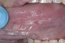In the early stages, mouth cancer rarely causes any pain. Detection Of Early Stage Oral Cancer Lesions A Survey Of California Dental Hygienists University Of The Pacific
