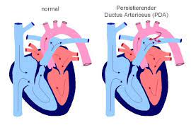 La soccer club is a soccer club consisting of an open team and several teams in the southern. Persistierender Ductus Arteriosus Pda