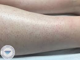 Browse our prices for laser hair removal, skin rejuvenation, waxing, and electrolysis. Laser Hair Removal For Women Simply Laser Hair Removal