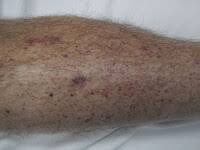 Kersenwratjes Symptomen Van Kleine Rode Bultjes Op De Huid Mens En Gezondheid Aandoeningen Symptomen kersenwratjes komen veel voor. kleine rode bultjes op de huid