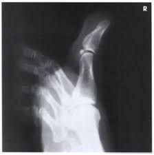 Lateral Projection Toes Radtechonduty