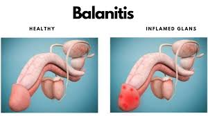 Image result for balanoposthitis