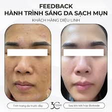 🌟 FEEDBACK CHƯƠNG TRÌNH “HÀNH TRÌNH SÁNG DA SẠCH MỤN” Khách hàng: Diệu  Linh ❗️ Trước khi sử dụng liệu trình:
