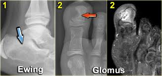 Symptoms of a bone tumor may include: The Radiology Assistant Differential Diagnosis Of Bone Tumors