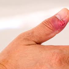 Fungal treatments do not work if the acrylic nail is still attached. Paronychia Symptoms Causes Diagnosis And Treatment