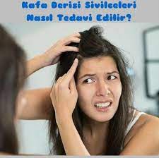 Kafa Derisinde Cikan Sivilceler Dogal Yollarla Nasil Gecirilir Hair Dandruff Getting Rid Of Dandruff Dandruff Treatment