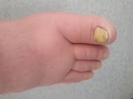 Image result for Yellow nail syndrome feet