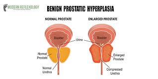 5 Acupressure Points To Treat Prostate Gland Enlargement