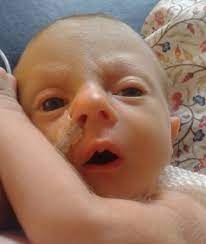 Edwards syndrome is a genetic condition that results in slow growth in utero or low birth weight. Trusting Doctors When Your Child Has Edwards Syndrome Soft Uk