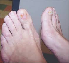 Is it important for jeff to make quick decisions? How To Detect Nail Unit Tumors Podiatry Today