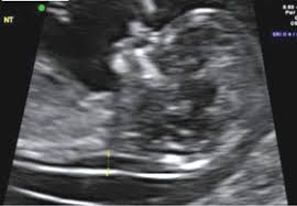Check spelling or type a new query. Ultrasound Pregnancy Test Near Me Pregnancy Test