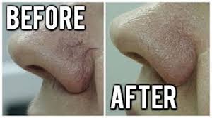 If you are looking for 100% certain way on how to get rid of spider veins on face, then you do not skip coconut oil. Treating Spider Veins On Nose Youtube