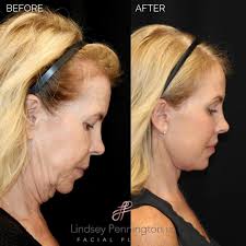Lindsey Pennington, M.D. Facial Plastics