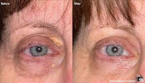Image result for xanthelasma of eyelid